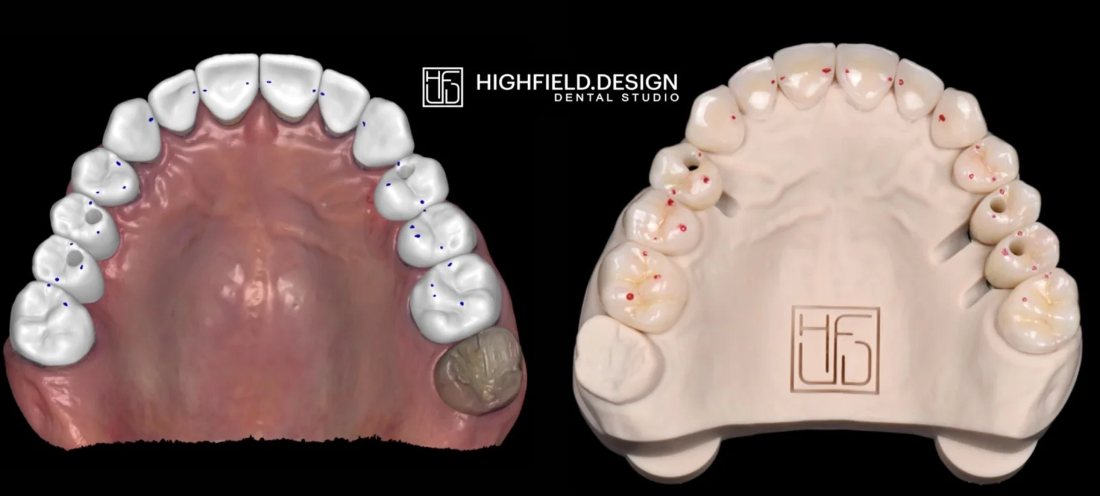 CAD contact points on the left matching occlusal-paper marks on the mounted model on the right