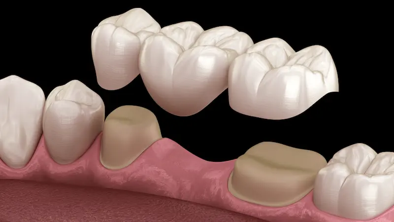 Single crown — standard case