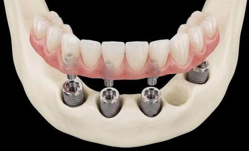 Full-arch implant case